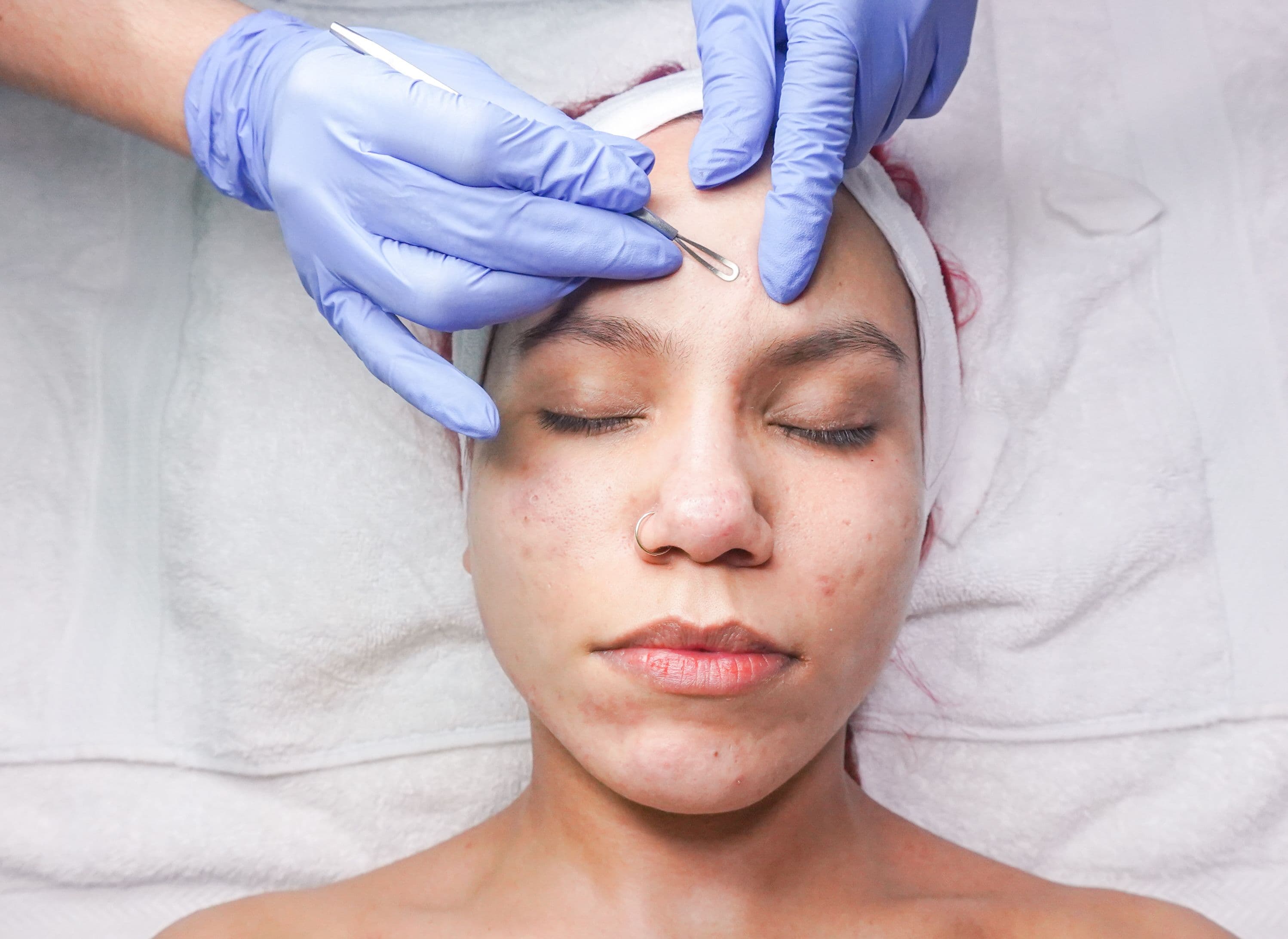 Acne-fighting skincare products including salicylic acid and niacinamide serum on a clean surface
