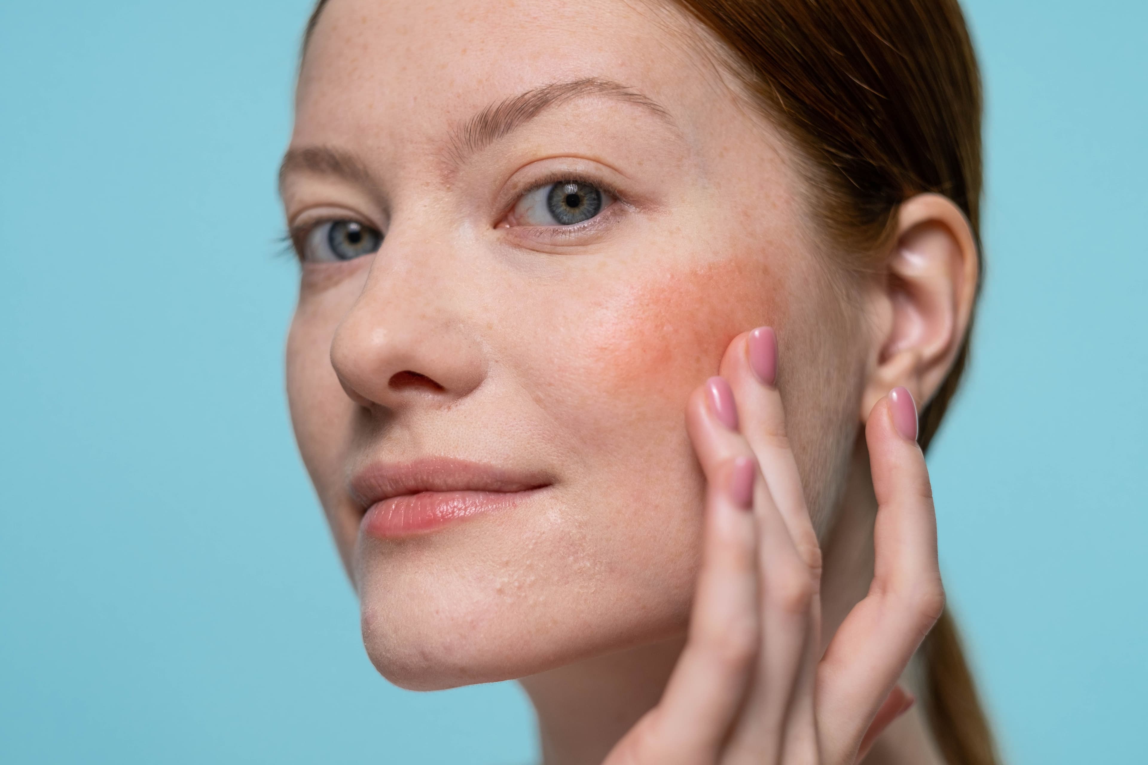 Close up of woman's face with mild facial redness on cheeks